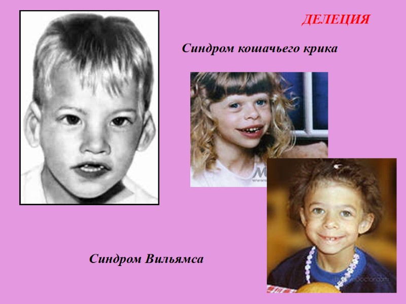 Синдром кошачьего крика Синдром Вильямса ДЕЛЕЦИЯ